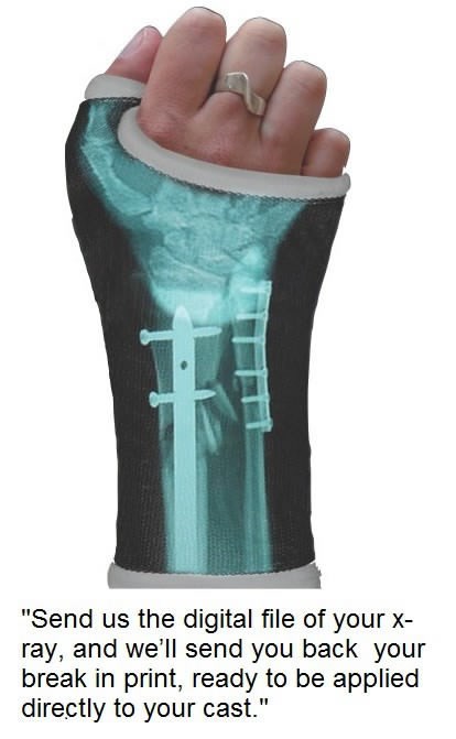 Od rentgenske snimke izrađuju naljepnice za gips