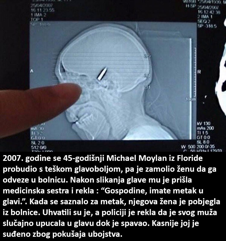 Muškarac se probudio s metkom u glavi?!