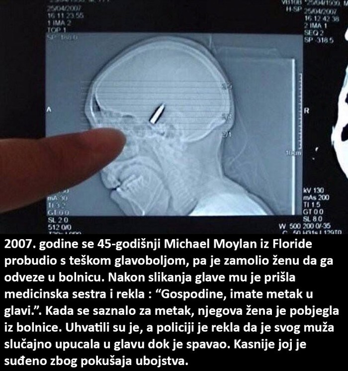Muškarac se probudio s metkom u glavi?!