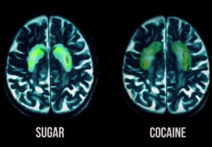 Mozak na šećeru je mozak na kokainu