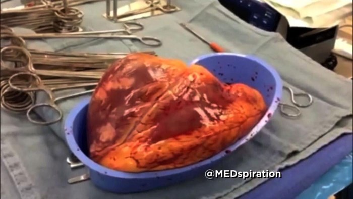 VIDEO Srce je kucalo 25 minuta nakon što je izvađeno iz tijela, šokirani doktori su otkrili kome je pripadalo
