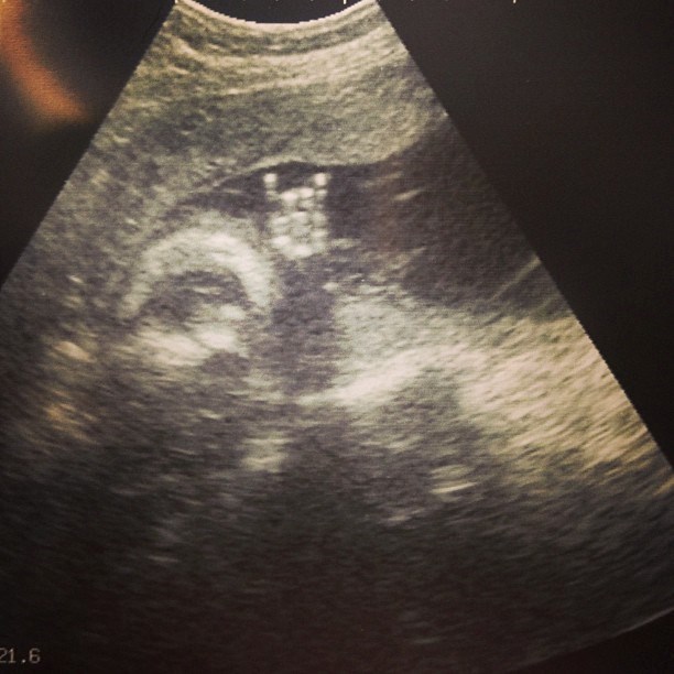 Mali metalac "roka" već iz trbuha