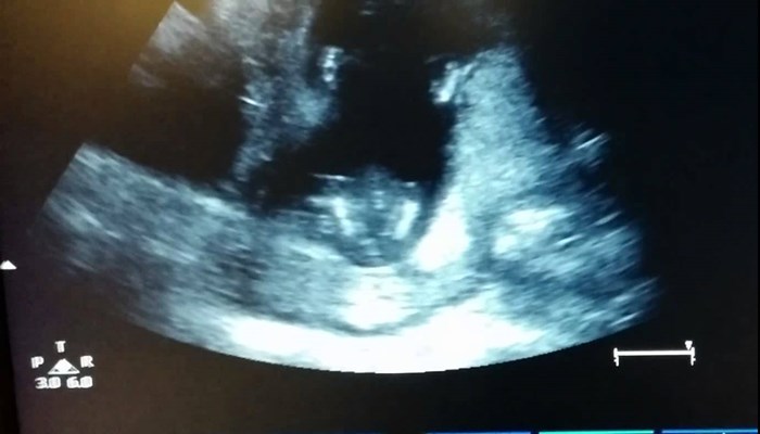 VIDEO: Ultrazvuk ove trudnice sve prisutne je ostavio bez daha!