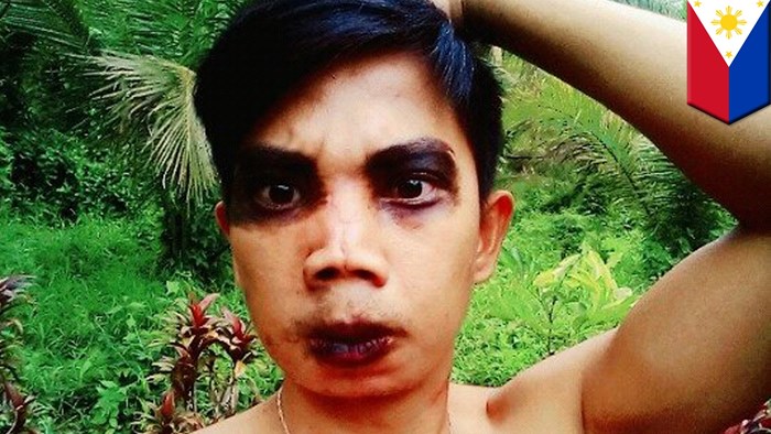 Mladić sebi uništio lice estetskom operacijom koju je platio 70 kuna, pogledajte kako sad izgleda!