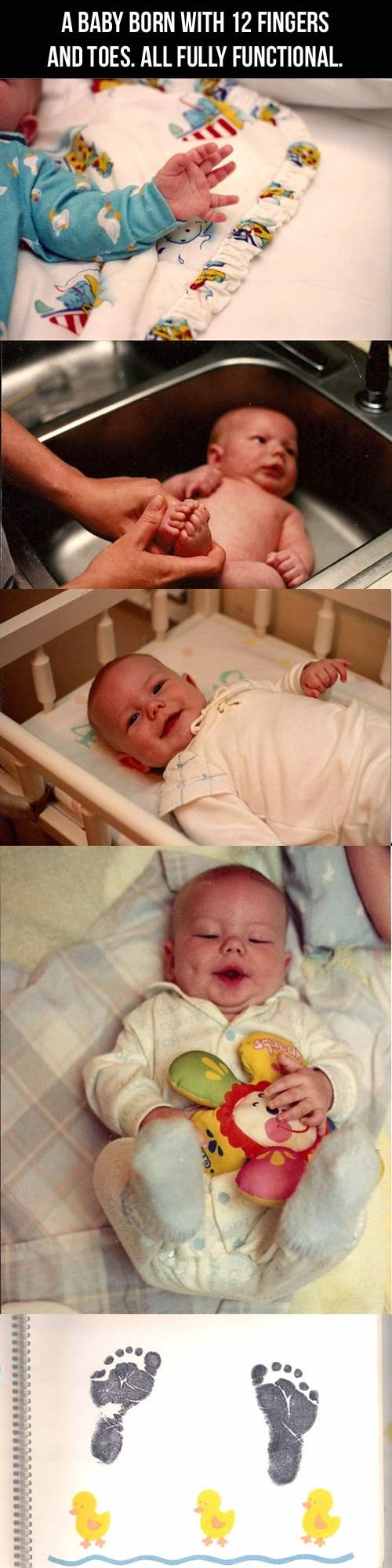 Bebica rođena s po šest prstiju na rukama i nogama