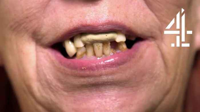 VIDEO Žena koja je ostala bez prednjih zubi pokazala je kako taj nedostatak maskira već godinama