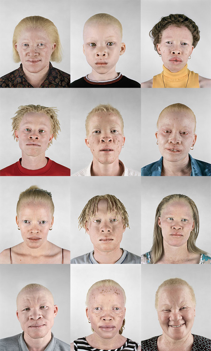 Razlike nas spajaju: Lica albino crnaca