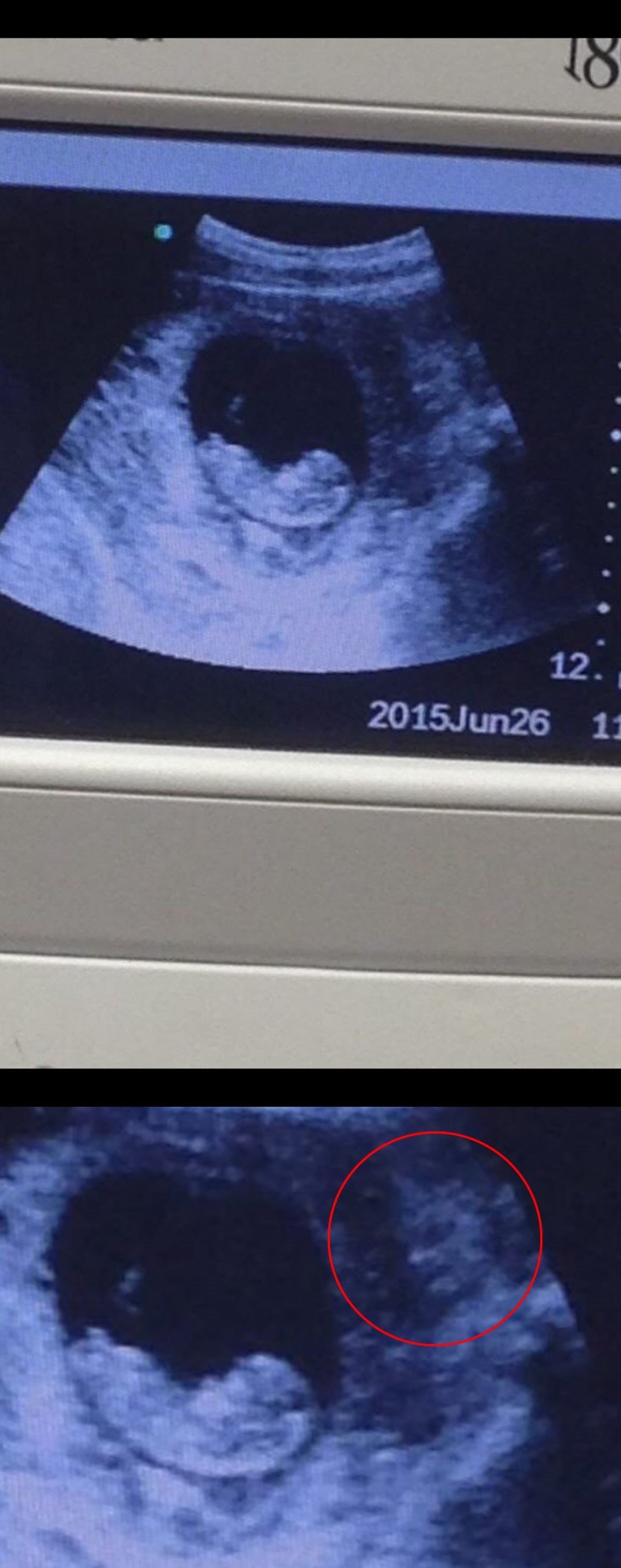 Na ultrazvuku bebe otkriven demonski čuvar!?