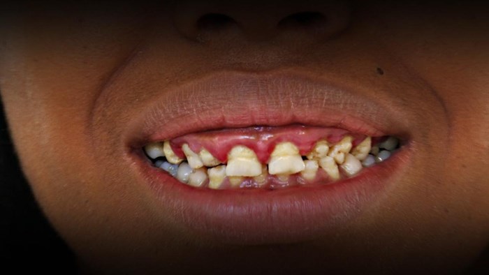 VIDEO Ova žena nikad nije izgubila svoje mliječne zube, evo kako danas izgleda!