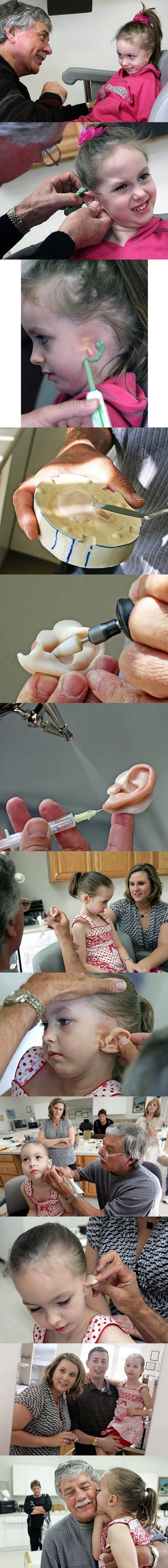 Djevojčica dobila novo uho, a s njim se vratio i osmijeh