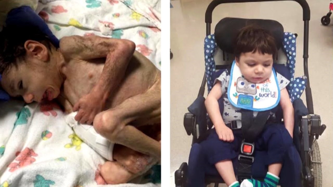 Nevjerojatna transformacija 8-godišnjaka koji je zbog izgladnjelosti ostao nerazvijen