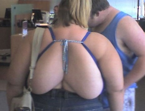 Kad od ekstremne debljine dobiješ "sise" na leđima