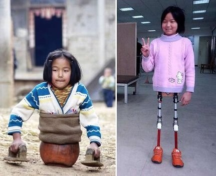 Djevojčica dobila noge: Znanost joj uljepšala život