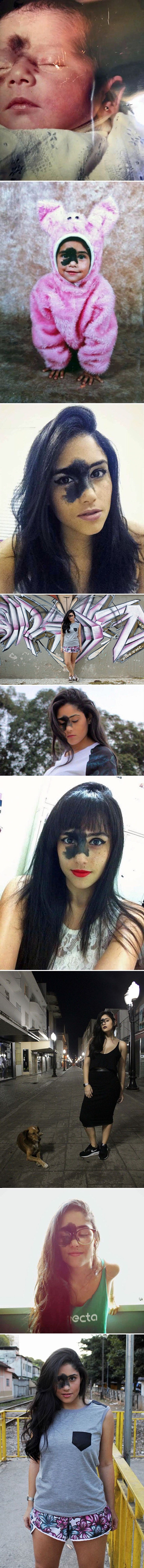 Djevojčica je odbijala ukloniti veliki madež s lica iako su joj se rugali, danas izgleda prelijepo i unikatno!