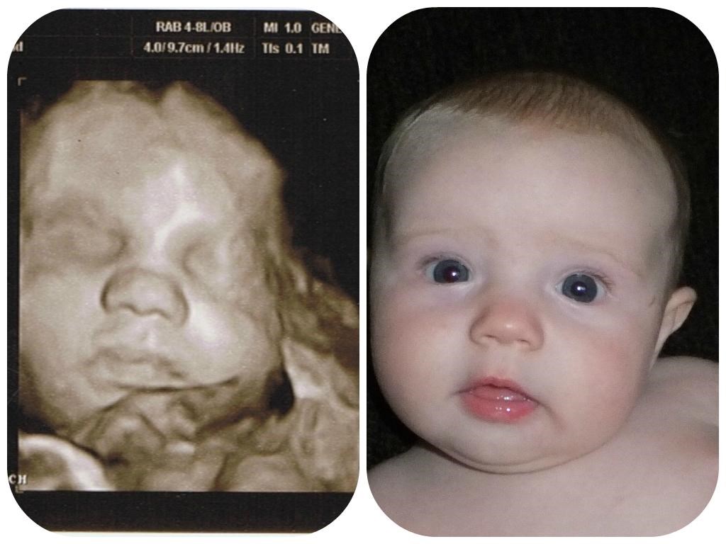 Koliko je precizan 4D ultrazvuk nerođene bebe