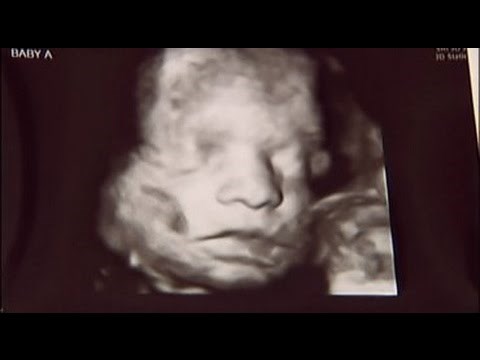 Doktori su roditeljima rekli da beba neće preživjeti, onda su pogledali ultrazvuk...