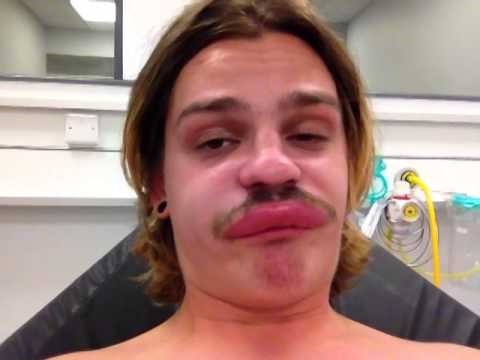 Mladić završio u bolnici zbog uboda kukca, estradne dive mu zavide na novoj gornjoj usni!