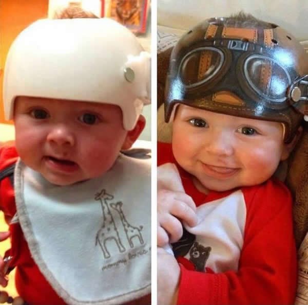 Bolesni mališani više ne plaču zbog kaciga