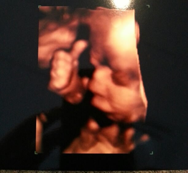 Nerođena beba dala "palac gore" preko 3D ultrazvuka