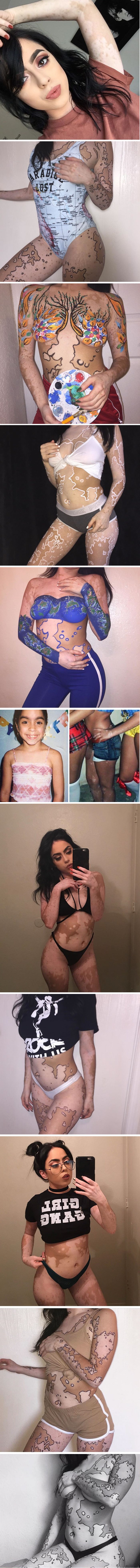 Cijelog su je života ismijavali zbog kožne bolesti, a onda je svoje tijelo pretvorila u umjetnost