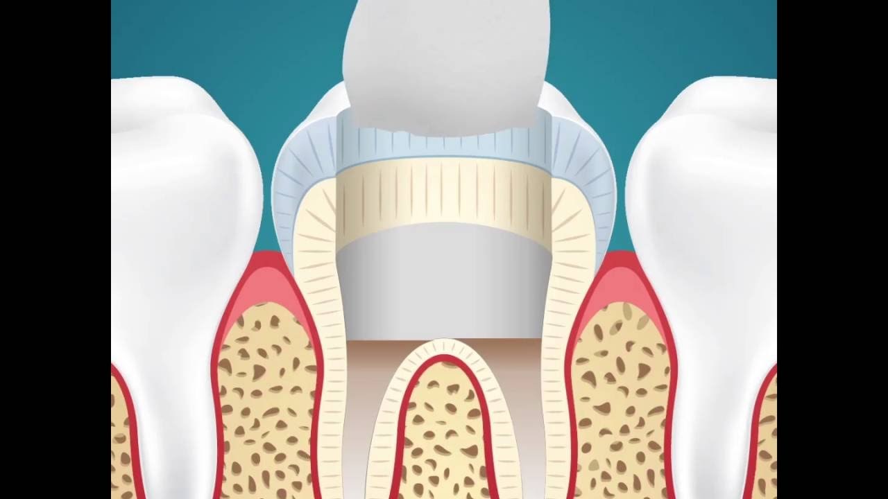 FORA ANIMACIJA: Što zubar zapravo radi kad nam popravlja zube?