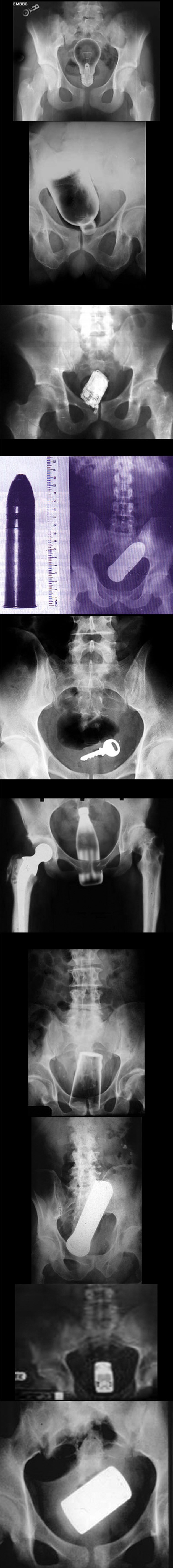 Kako se čovjeku dogodi da ključeve zaboravi u - guzici?