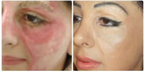 Tattoo majstor opečenoj ženi vratio samopouzdanje