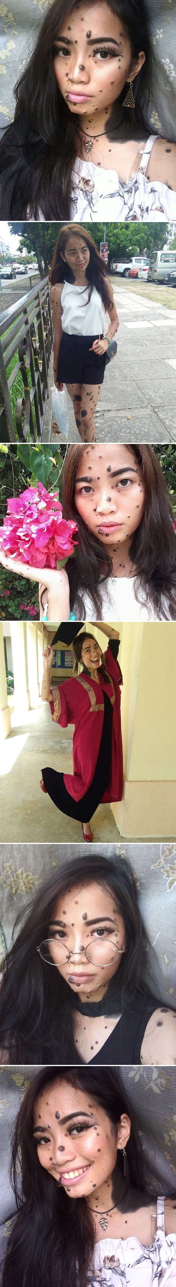 U školi su je zbog madeža nazivali čudovištem, a sada bi mogla postati nova Miss Universe!