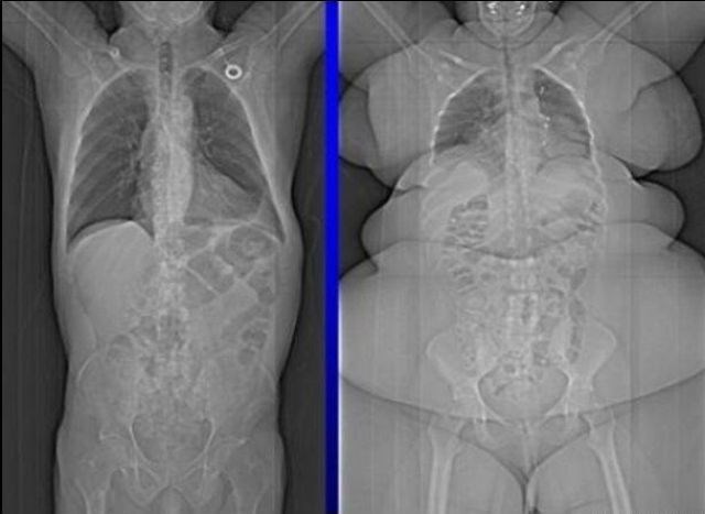 Jadni kosturić trpi stotine kila sala