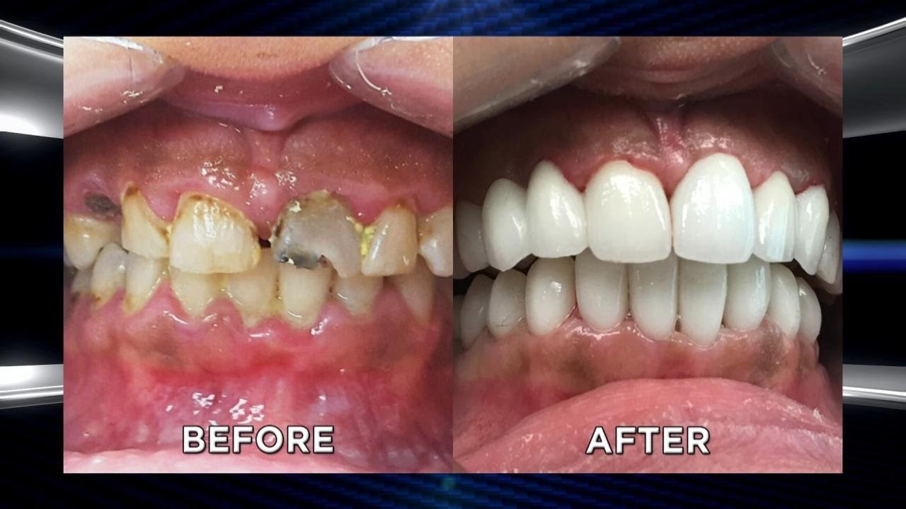 VIDEO Bivša bulimičarka je imala strašne zube, rasplakala se kad je vidjela što joj je zubar uradio