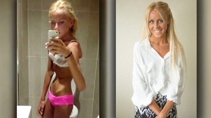 Ova je djevojka pobijedila anoreksiju nakon što je gotovo umrla zbog neuhranjenosti