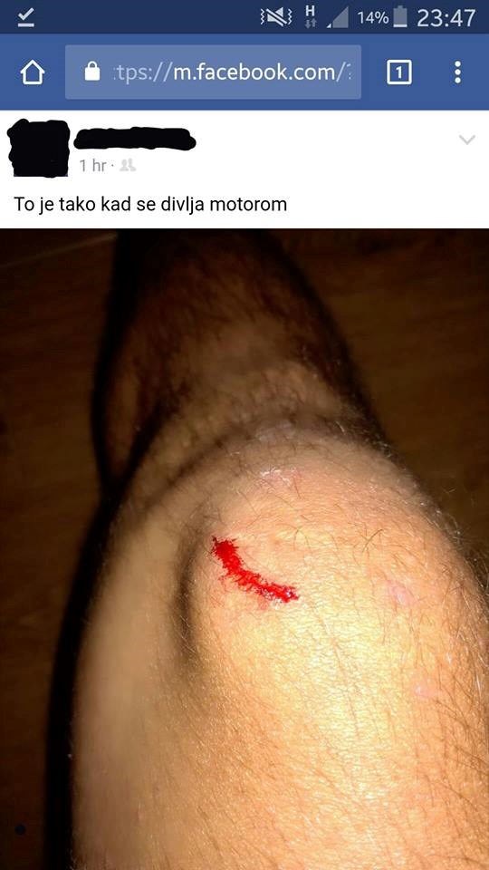 Divljao je na motoru pa na Facebooku pokazao svoju "strašnu" ozljedu