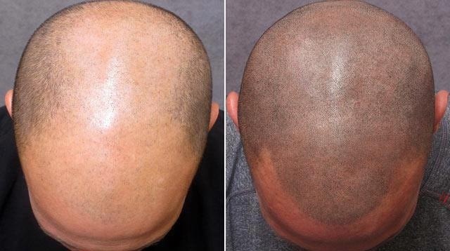 I ćelavost se da sakriti - tetovažom