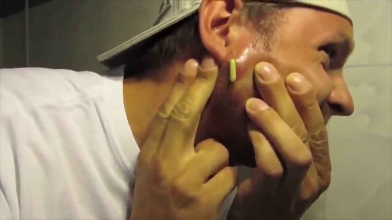 Tiskanje ogromnog prišta najodvratnija je stvar koju ćete danas vidjeti 