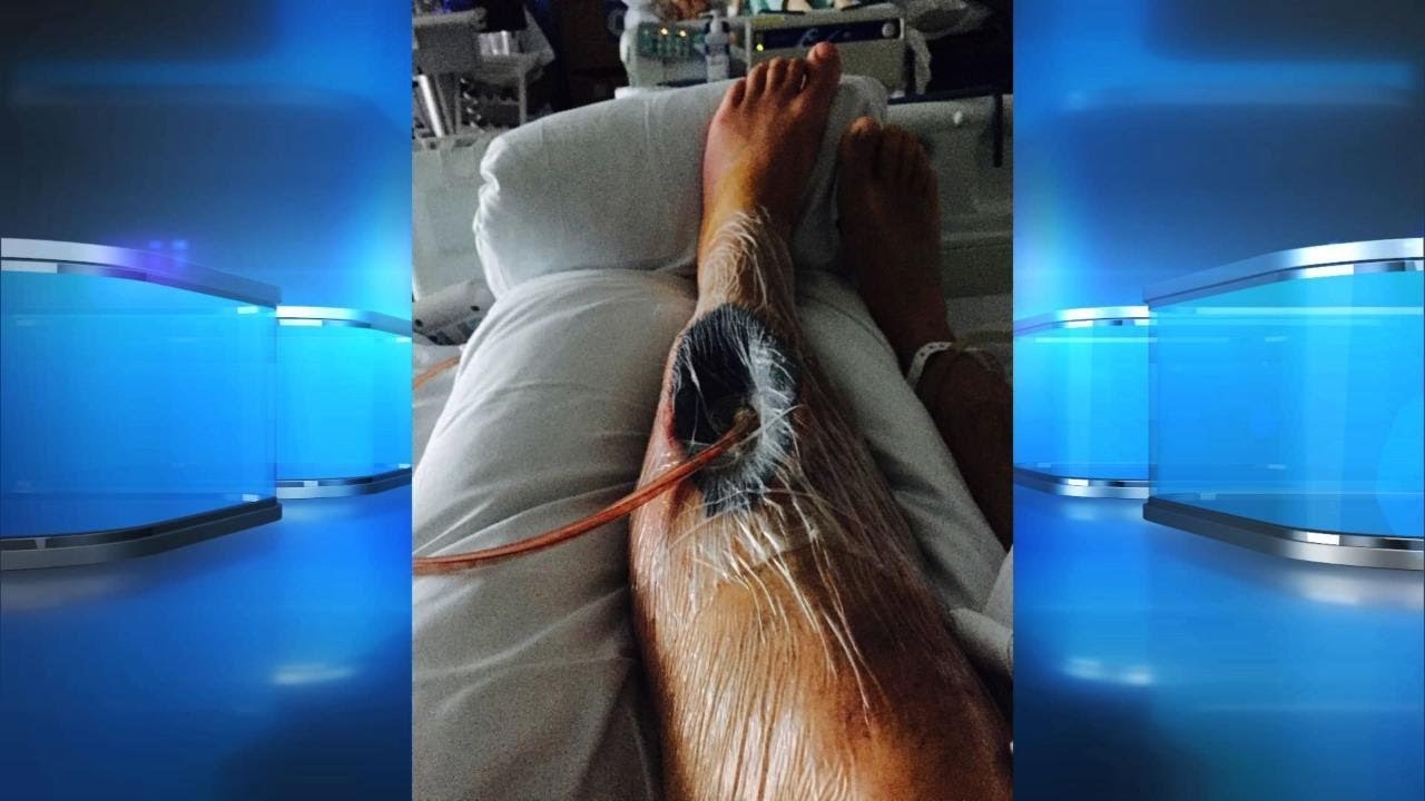 OPASNA DIJETA Izgubio dio noge nakon što se predozirao tabletama za mršavljenje