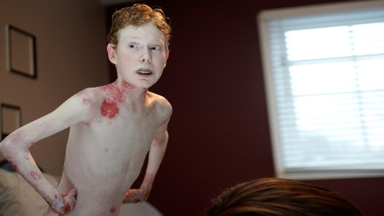 Ovom dječaku koža otpada na najmanji dodir, ali njegov um će vas ostaviti u suzama