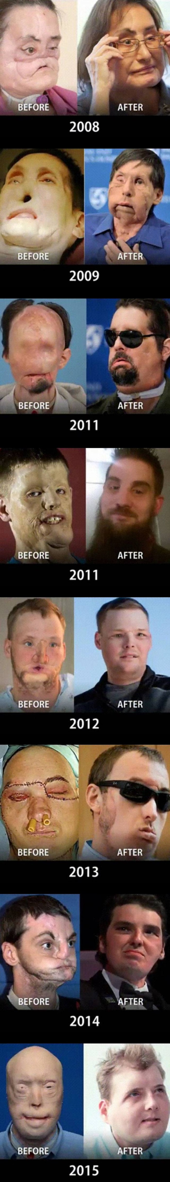 Transplantacije lica su iz godine u godinu sve uspješnije, pogledajte koliko su promijenile ove ljude!