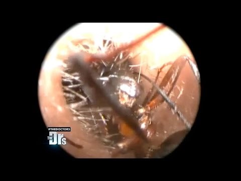 VIDEO Publici se koža naježila kad su vidjeli što su doktori izvadili djevojci iz uha