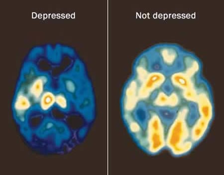 Usporedba mozga depresivne i raspoložene osobe