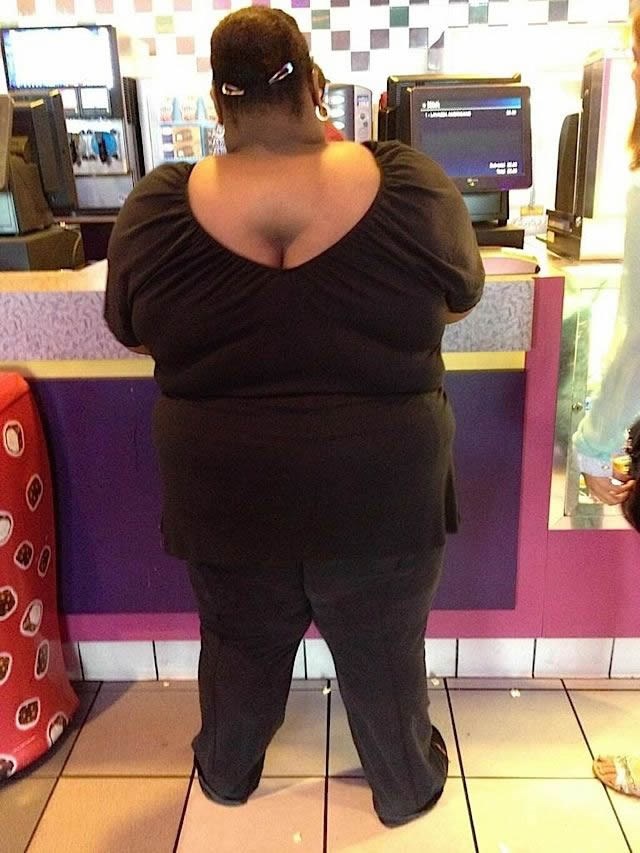 Kad ti je dekolte na leđima: Rezultat žderanja fast fooda