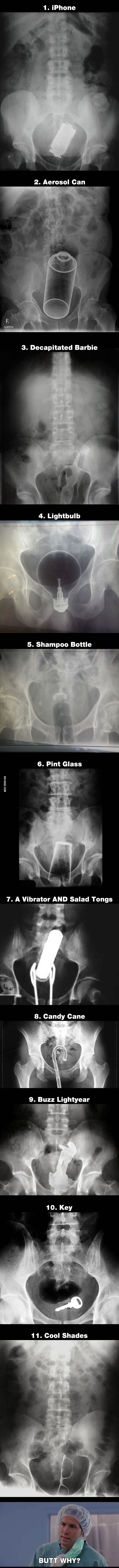 TOP 11 bolnih rentgenskih snimki predmeta pronađenih u anusima