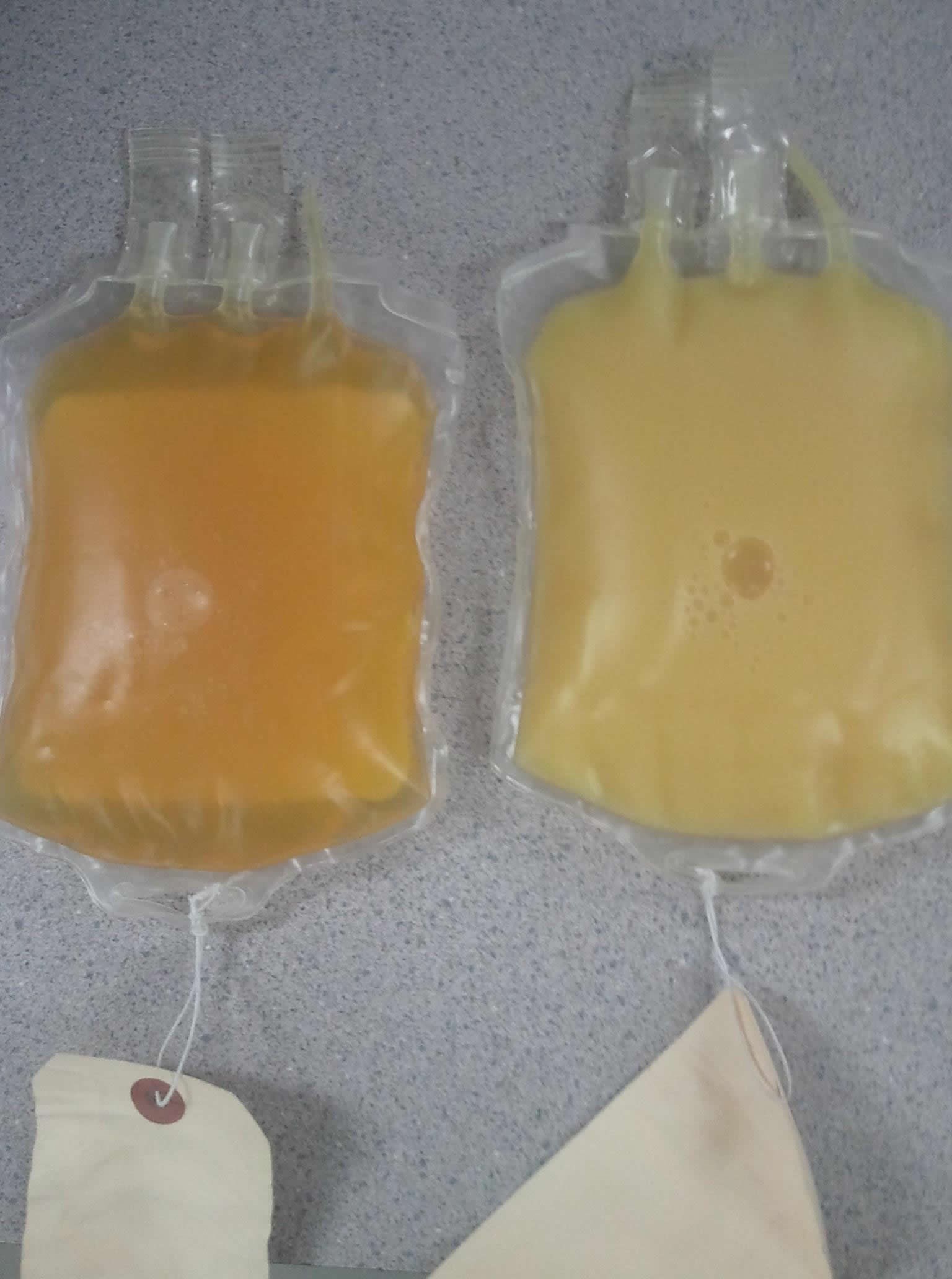 Donirana krvna plazma pokazuje tko jede hrpu masti