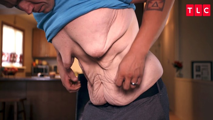 VIDEO Vlastito tijelu mu se počelo gaditi nakon što je skinuo više od 130 kg