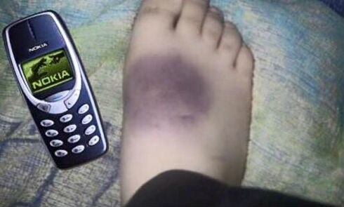 Mobitel mu pao na nogu, zamalo ostao bez noge
