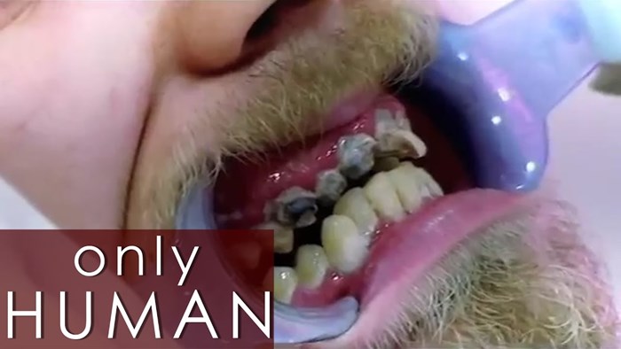 VIDEO Morao je izvaditi 11 zubi jer ih godinama nije prao, pogledajte što je zubar vidio kad je pacijent otvorio usta!