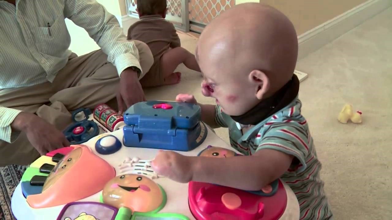 Rođen je bez nogu i nosa, pa su ga ostavili da umre, ali pogledajte ga danas!