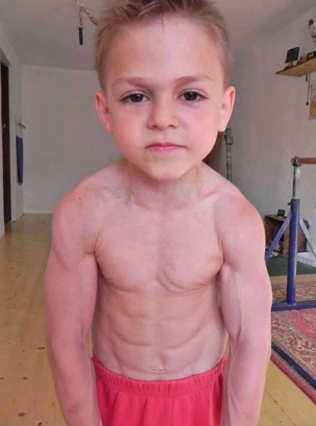 Bilderklinjo: Devetogodišnjak s pločicama