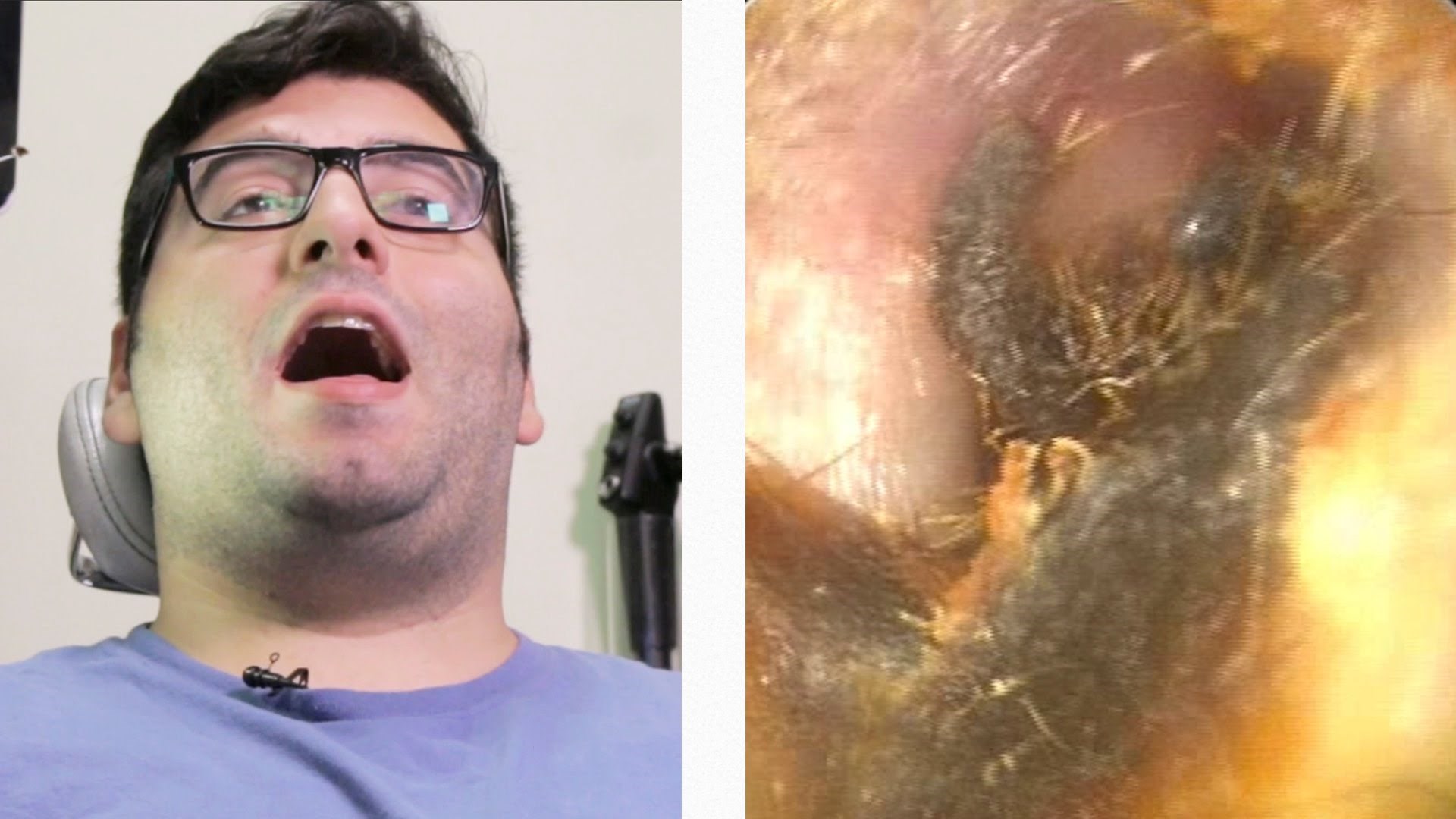 OBRATITE PAŽNJU: Pogledajte kakve se SVE nakupine nalaze u uhu! (VIDEO)