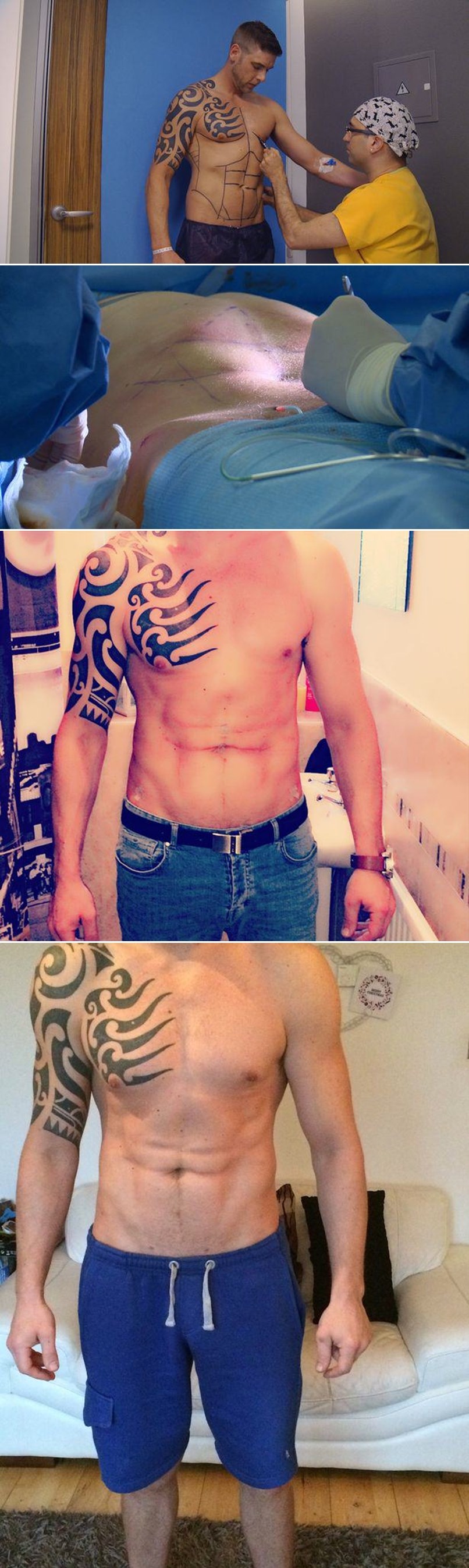 Potrošio bogatstvo na operaciju za savršene trbušnjake