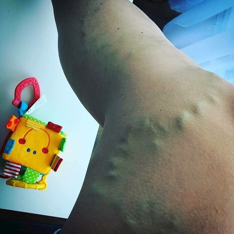 Varikozne vene također su učestale